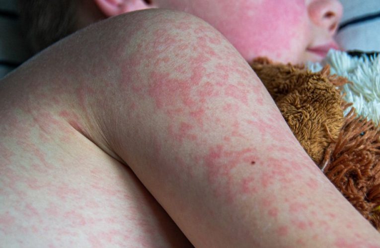 Measles Resurgence: 125 Cases Reported Across 17 States, CDC Concerned About Virus