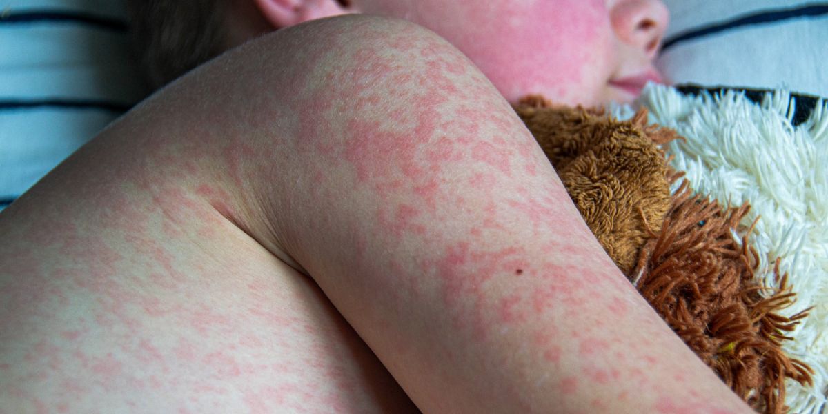 Measles Resurgence: 125 Cases Reported Across 17 States, CDC Concerned About Virus