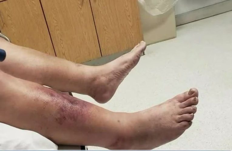 Shocking Shoreline! Man Faces Flesh-eating Bacteria After Beach Walk