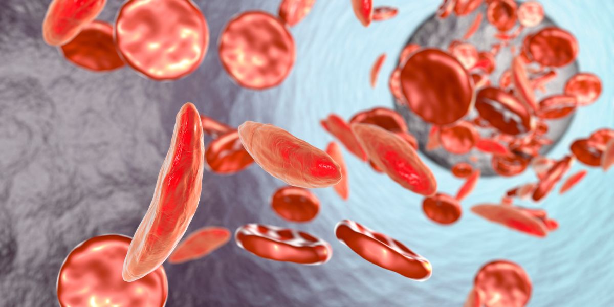 Alert! Florida Governor DeSantis Signs Bill to Support Sickle Cell Disease Research