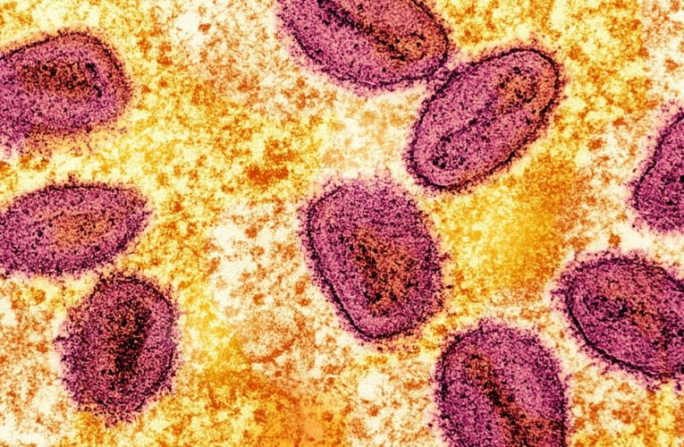 Fifth case of new deadly mpox strain detected in UK city – with NO link to other patients