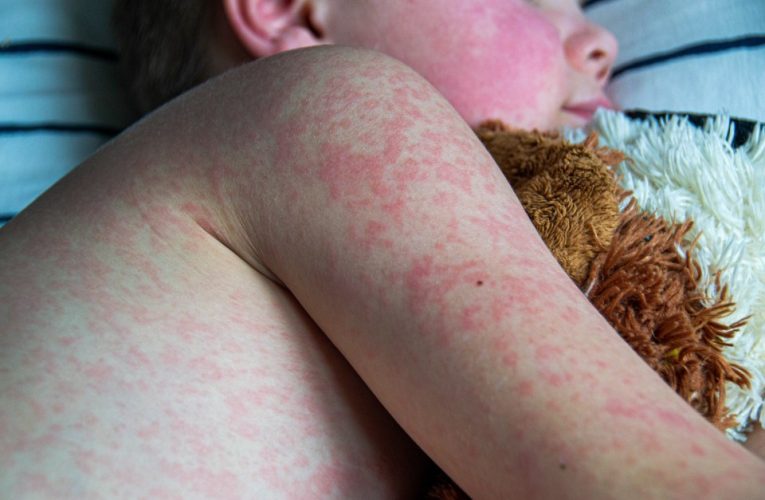 ‘World’s most infectious disease’ rockets 200% across Europe and under 5s most at risk, WHO warns